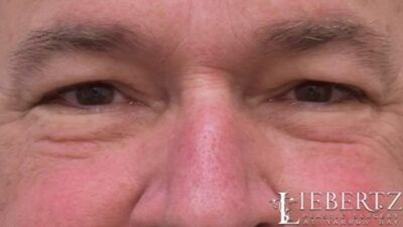 Blepharoplasty Before & After Gallery - Patient 985944 - Image 5