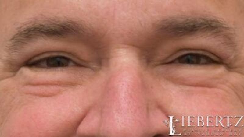 Blepharoplasty Before & After Gallery - Patient 985944 - Image 6