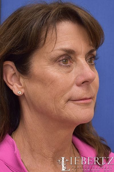 Necklift Before & After Gallery - Patient 156895 - Image 1