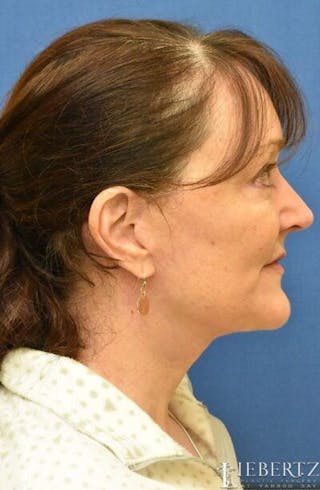 Facelift Before & After Gallery - Patient 196680 - Image 4