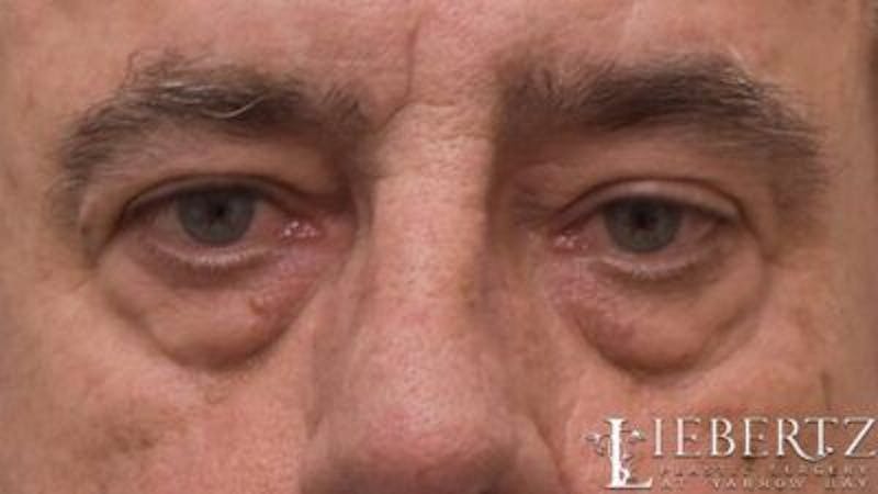 Blepharoplasty Before & After Gallery - Patient 390361 - Image 1