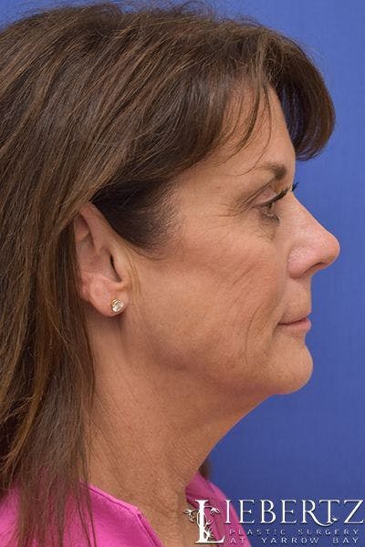 facelift