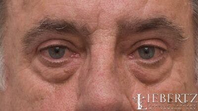 Blepharoplasty Before & After Gallery - Patient 390361 - Image 2