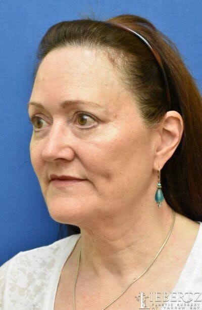 Facelift Before & After Gallery - Patient 196680 - Image 1