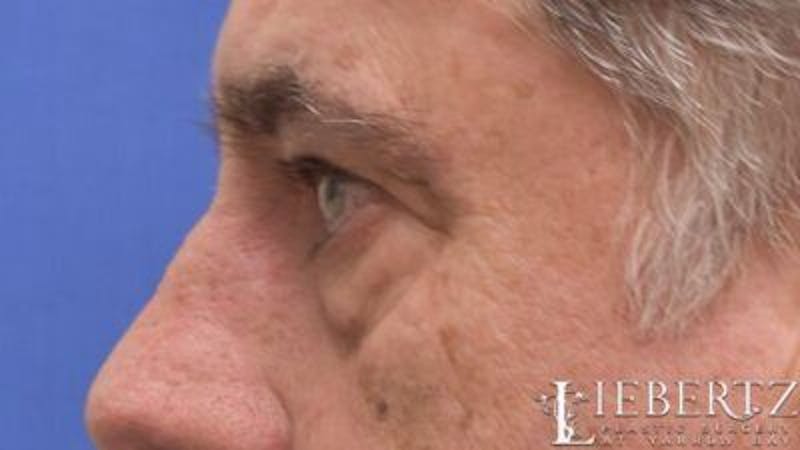 Blepharoplasty Before & After Gallery - Patient 390361 - Image 3