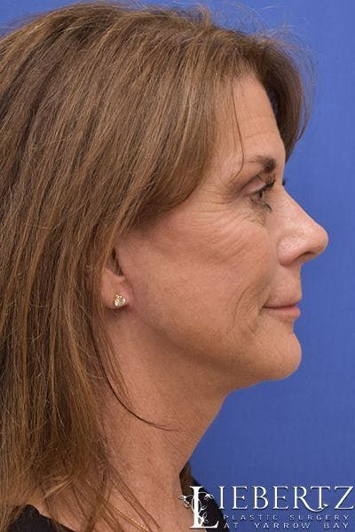 facelift