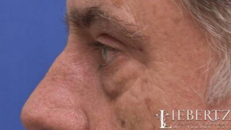 Blepharoplasty Before & After Gallery - Patient 390361 - Image 4