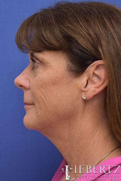 facelift