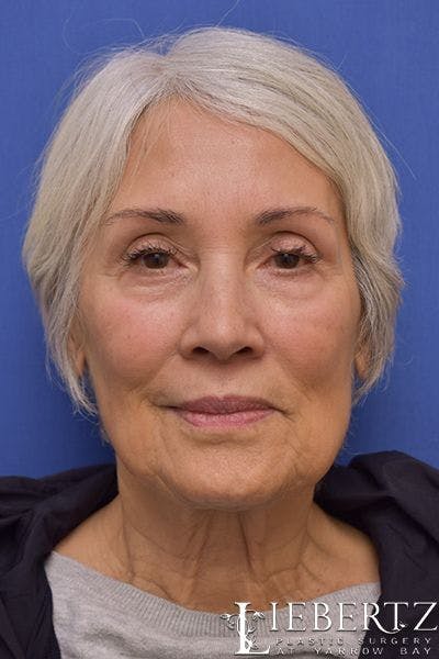 Facelift Before & After Gallery - Patient 290268 - Image 1