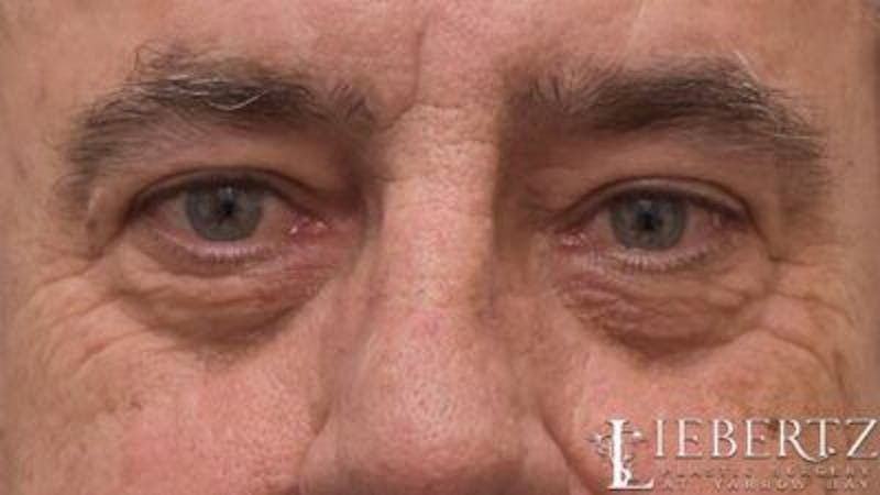 Blepharoplasty Before & After Gallery - Patient 390361 - Image 5
