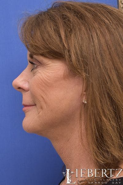 facelift