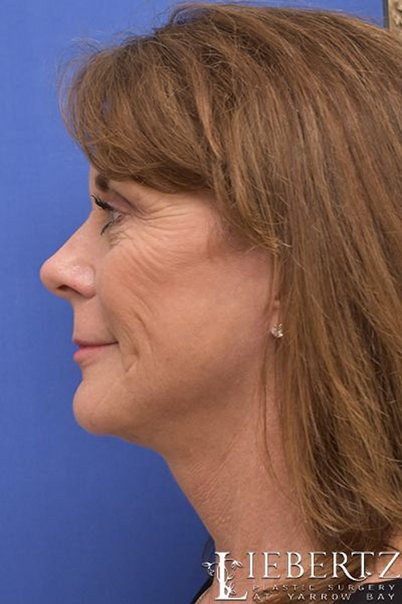 Necklift Before & After Gallery - Patient 156895 - Image 8