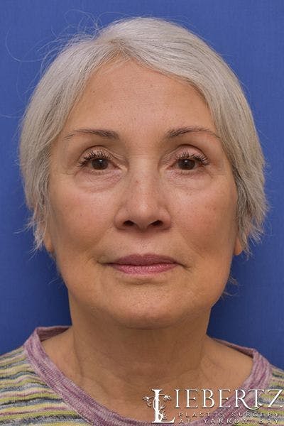 Facelift Before & After Gallery - Patient 290268 - Image 2