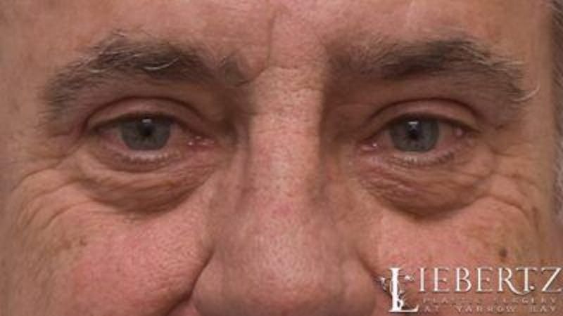 Blepharoplasty Before & After Gallery - Patient 390361 - Image 6