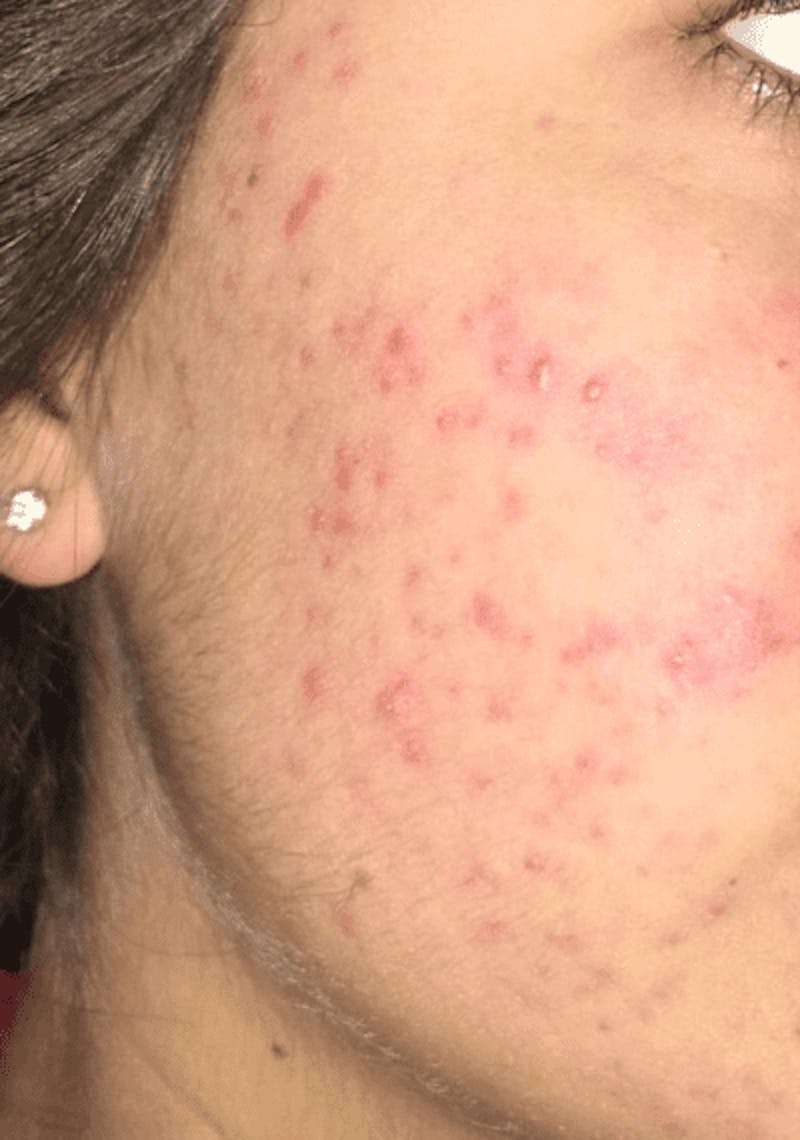 Microneedling Before & After Gallery - Patient 230381 - Image 1