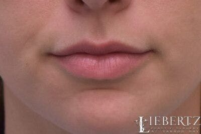 Lip Augmentation Before & After Gallery - Patient 288507 - Image 1