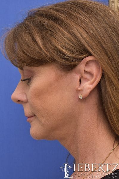 facelift