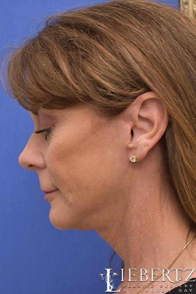 Necklift Before & After Gallery - Patient 156895 - Image 10
