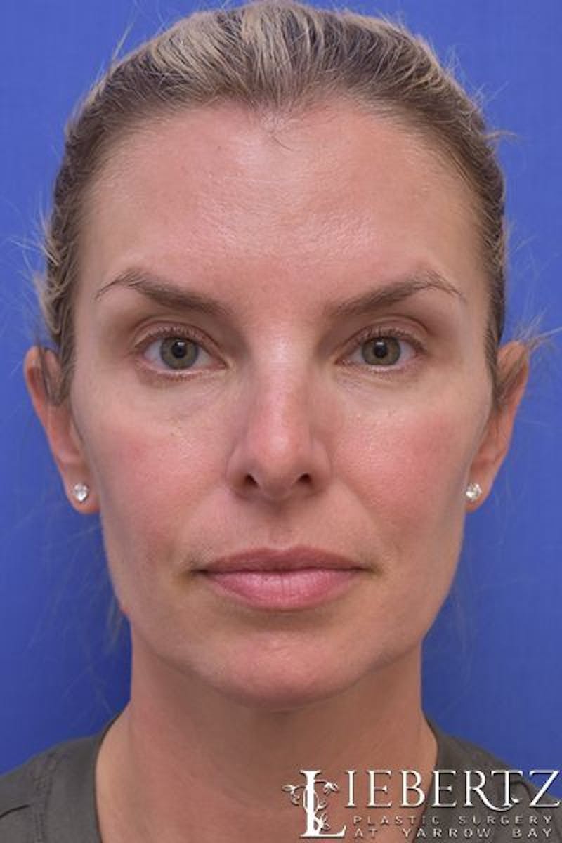 Blepharoplasty Before & After Gallery - Patient 186716 - Image 1