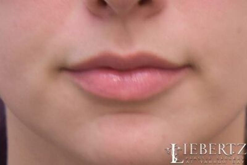 Lip Augmentation Before & After Gallery - Patient 288507 - Image 2