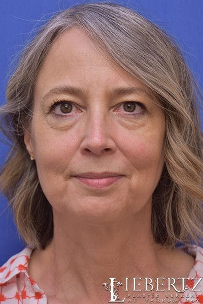 facelift