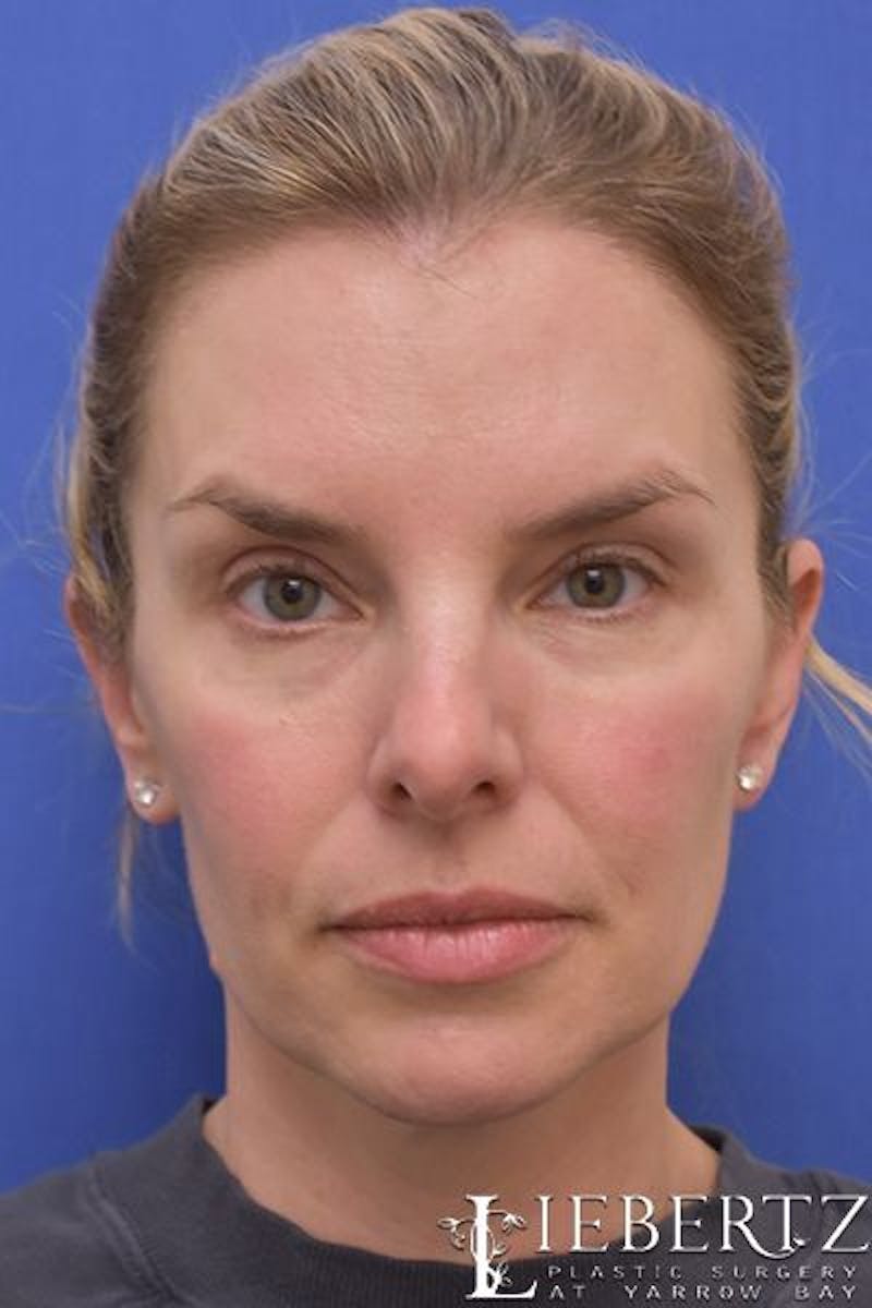 Blepharoplasty Before & After Gallery - Patient 186716 - Image 2