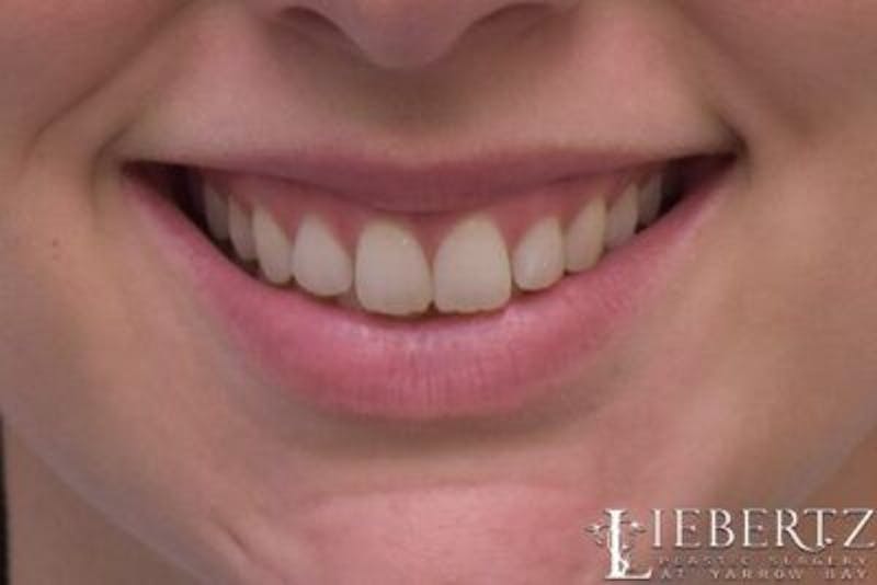 Lip Augmentation Before & After Gallery - Patient 288507 - Image 3