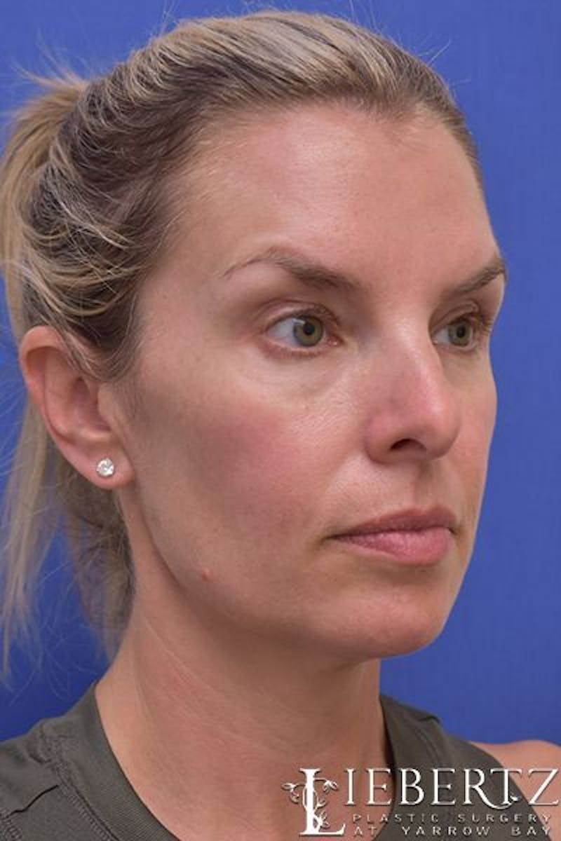 Blepharoplasty Before & After Gallery - Patient 186716 - Image 3