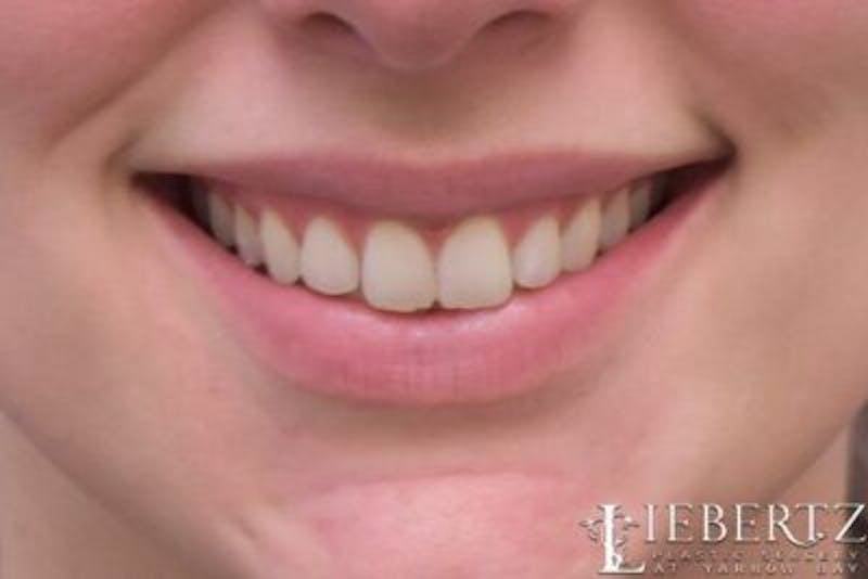 Lip Augmentation Before & After Gallery - Patient 288507 - Image 4