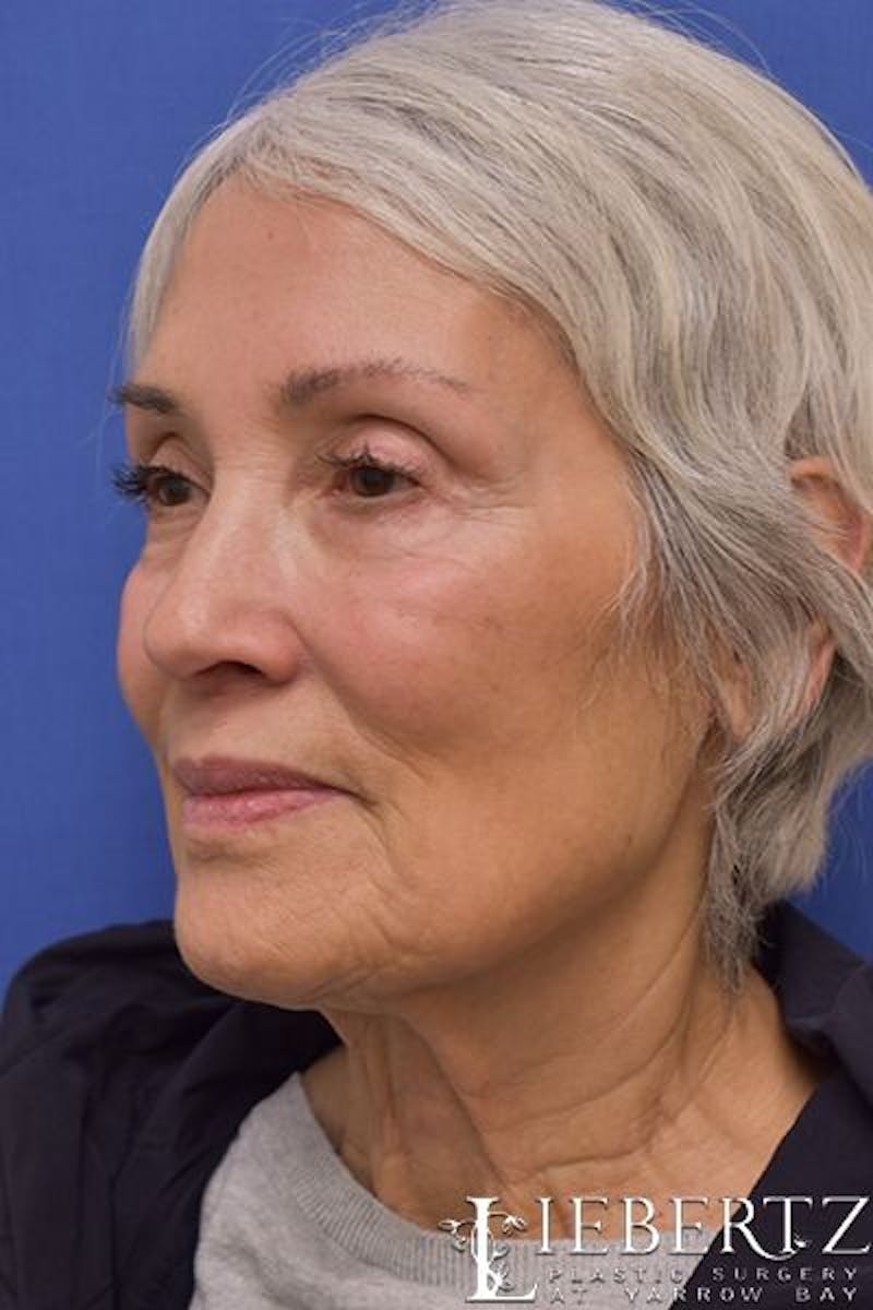 Facelift Before & After Gallery - Patient 290268 - Image 7