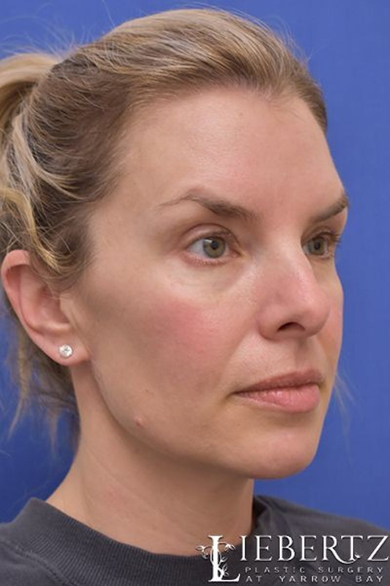 Blepharoplasty Before & After Gallery - Patient 186716 - Image 4