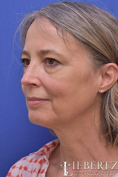 facelift