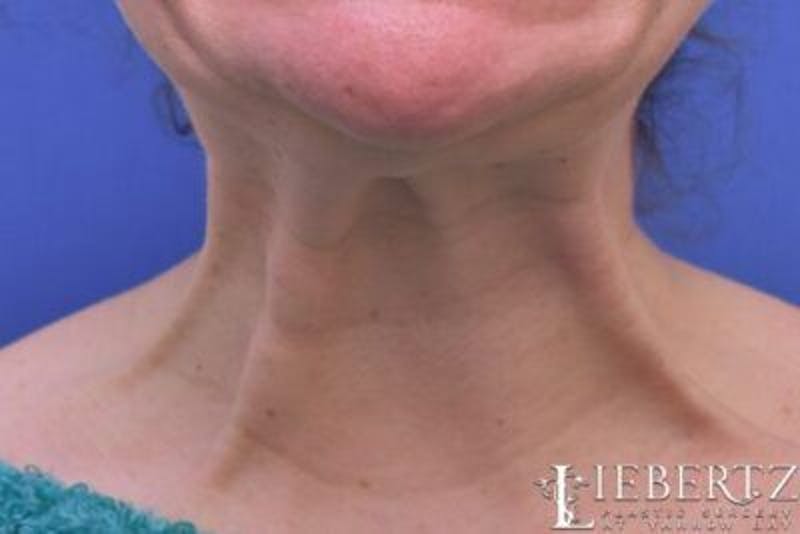 Wrinkle Relaxers Before & After Gallery - Patient 244124 - Image 1