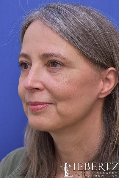 facelift