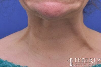 Wrinkle Relaxers Before & After Gallery - Patient 244124 - Image 2