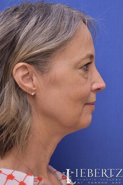 Necklift Before & After Gallery - Patient 141076 - Image 1
