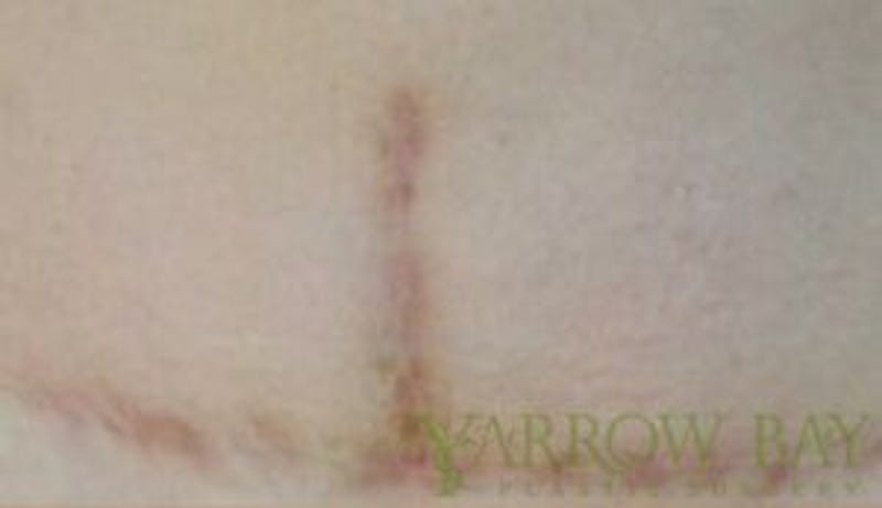 Scar Treatments Before & After Gallery - Patient 272692 - Image 1