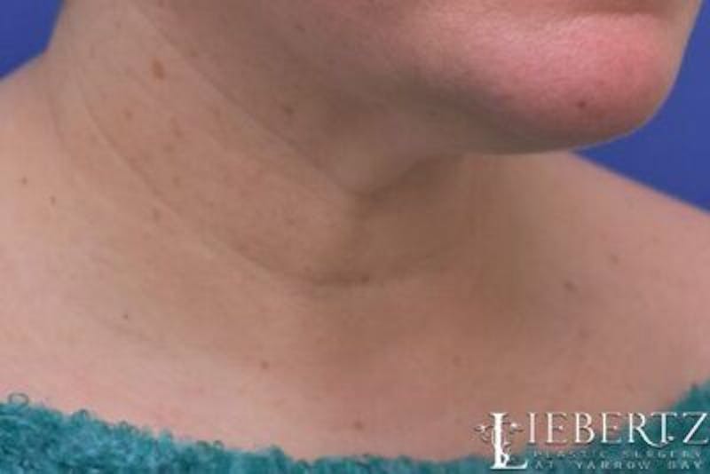 Wrinkle Relaxers Before & After Gallery - Patient 244124 - Image 3