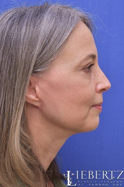 Necklift Before & After Gallery - Patient 141076 - Image 2