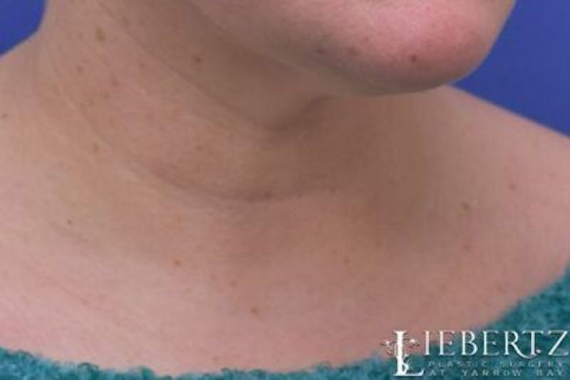 Wrinkle Relaxers Before & After Gallery - Patient 244124 - Image 4