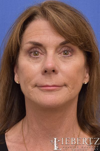 Facelift Before & After Gallery - Patient 296794 - Image 2