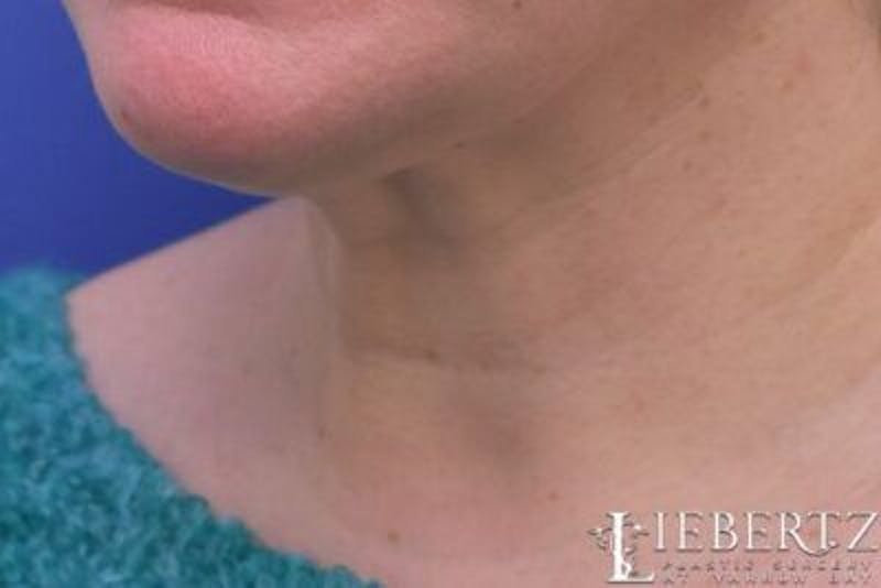 Wrinkle Relaxers Before & After Gallery - Patient 244124 - Image 5