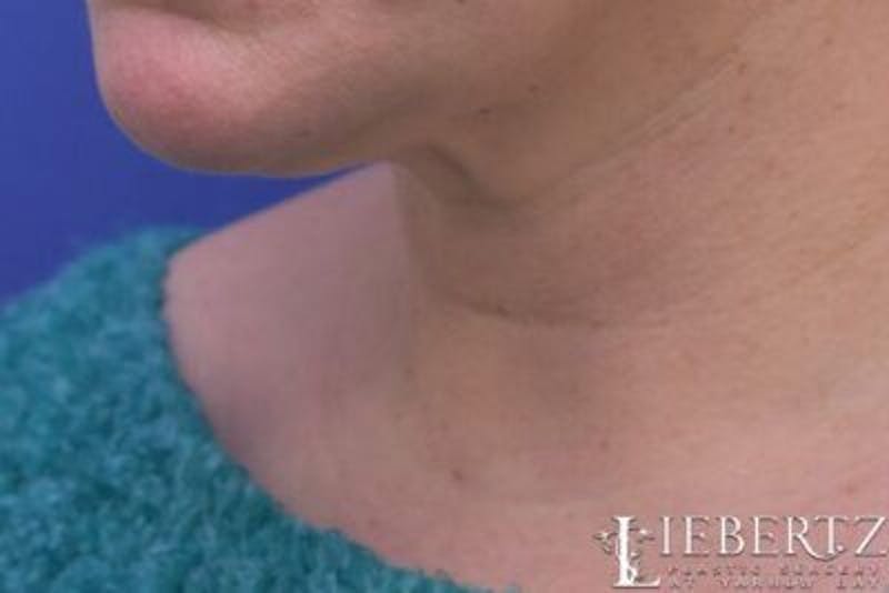 Wrinkle Relaxers Before & After Gallery - Patient 244124 - Image 6