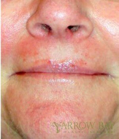 IPL & Laser Treatments Before & After Gallery - Patient 378368 - Image 1