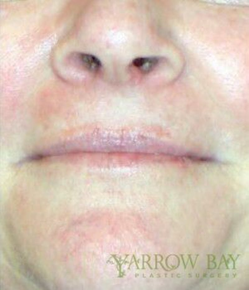 IPL & Laser Treatments Before & After Gallery - Patient 378368 - Image 2