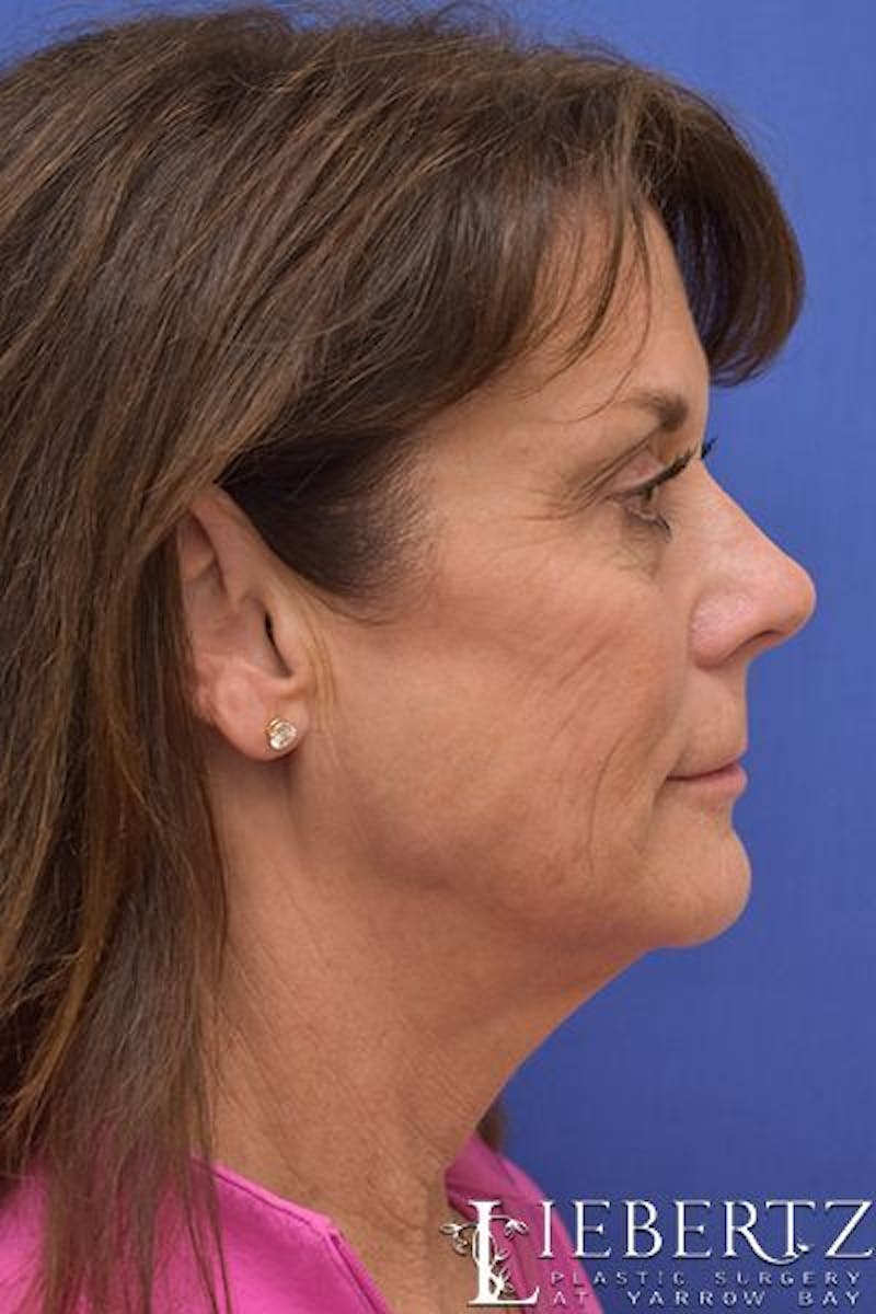 Facelift Before & After Gallery - Patient 296794 - Image 5