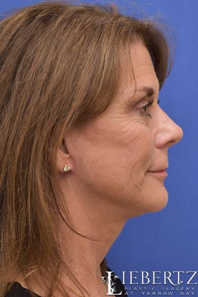 Facelift Before & After Gallery - Patient 296794 - Image 6