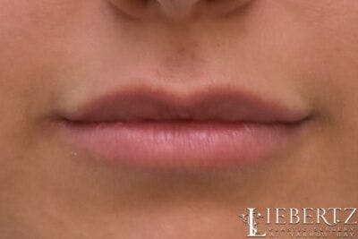 Lip Augmentation Before & After Gallery - Patient 382766 - Image 1