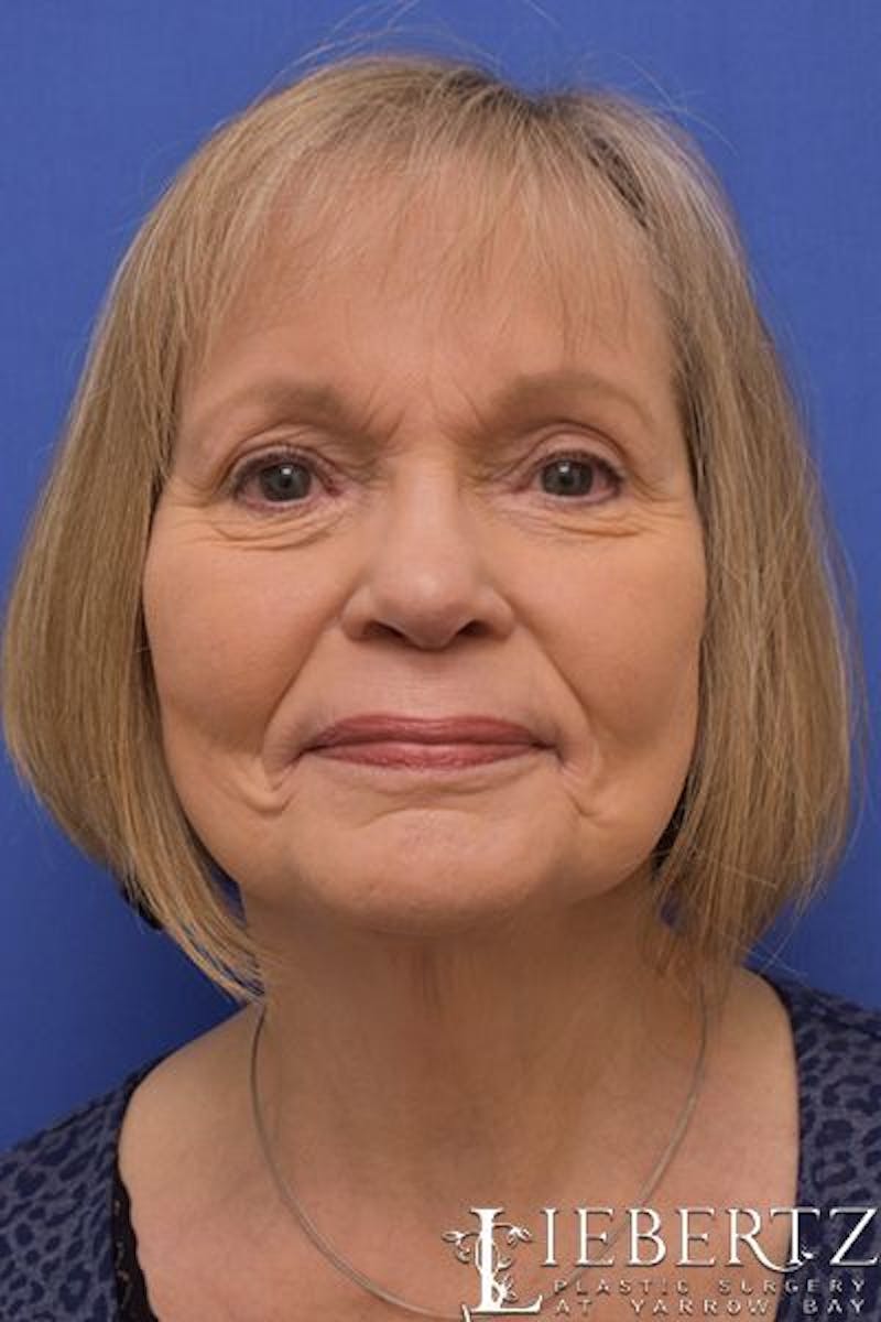 Necklift Before & After Gallery - Patient 877316 - Image 6