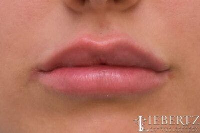 Lip Augmentation Before & After Gallery - Patient 382766 - Image 2